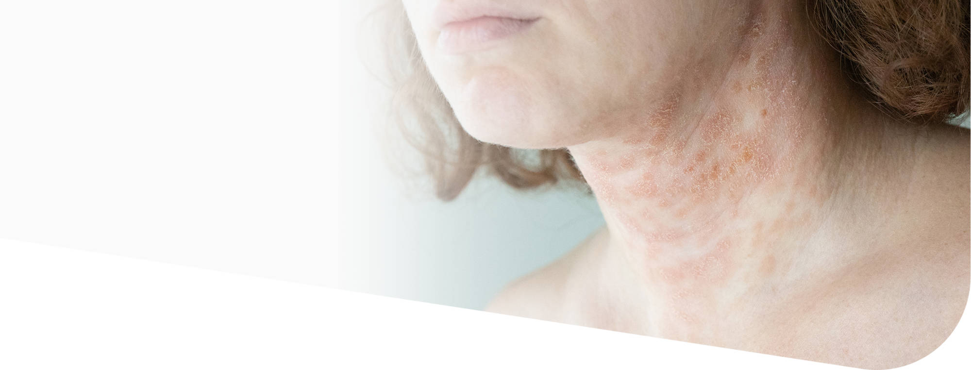 Дерматоз лица и шеи: причины, симптомы и лечение