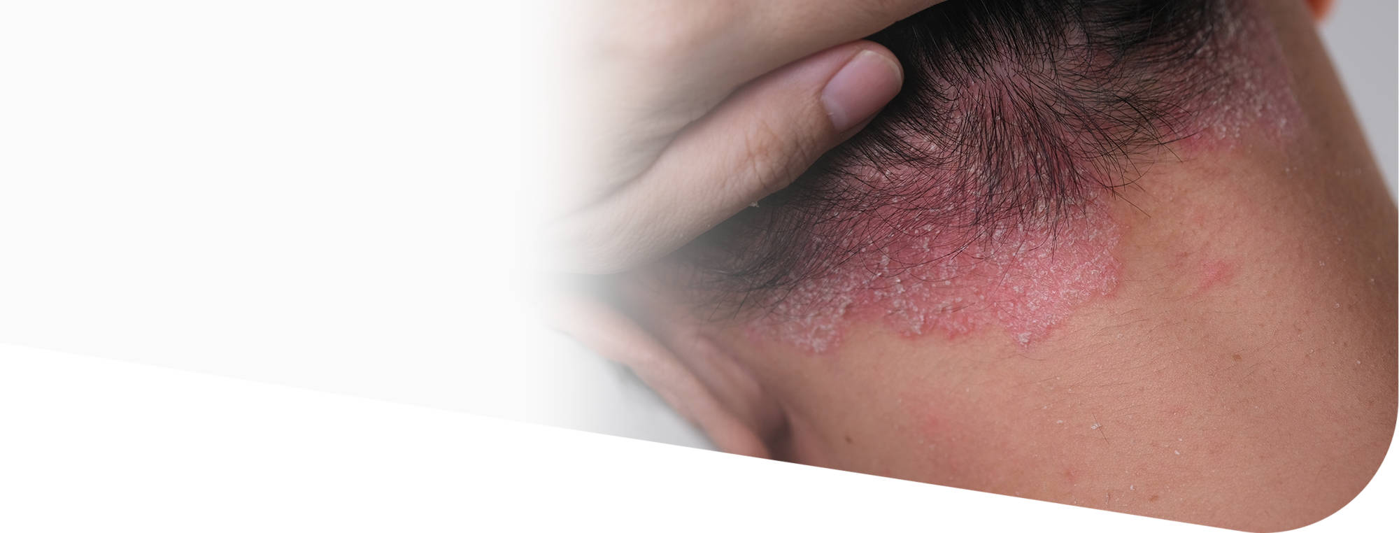 Псориаз