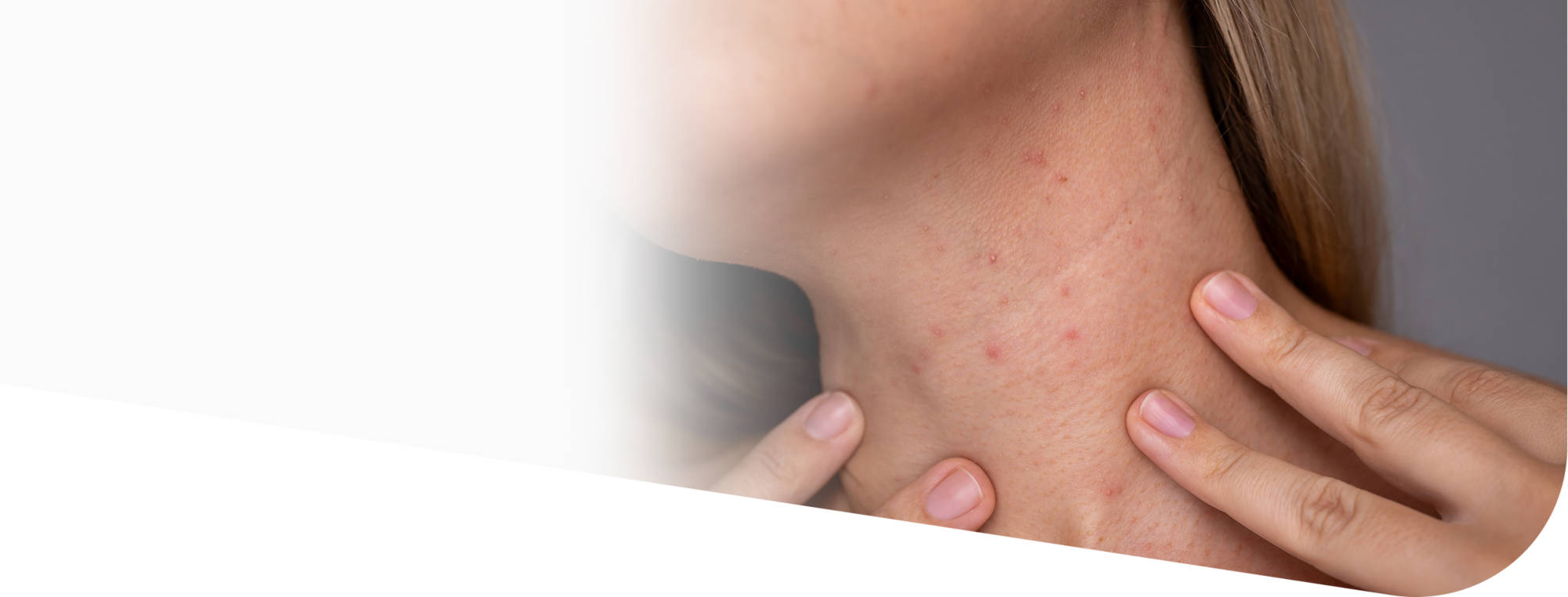 Гипоаллергенная диета при дерматите