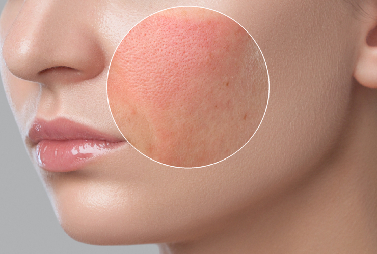 Аллергический контактный дерматит на лице