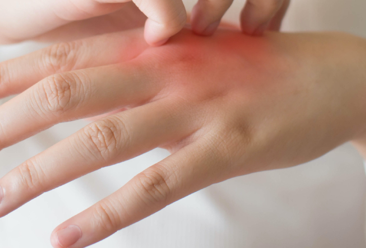 Аллергический дерматит на руках