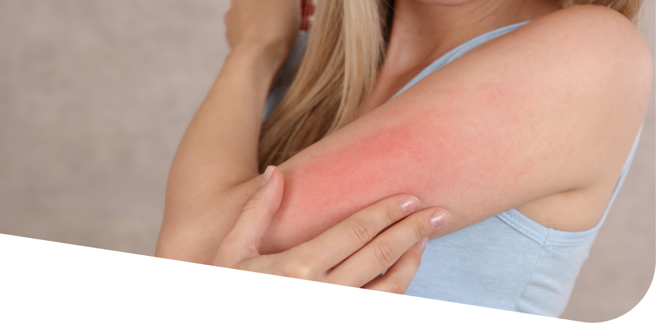 Покраснение на коже руки