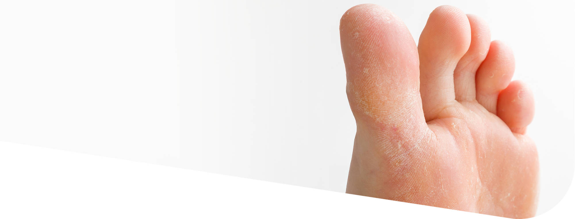 Грибок на ногах (микоз)