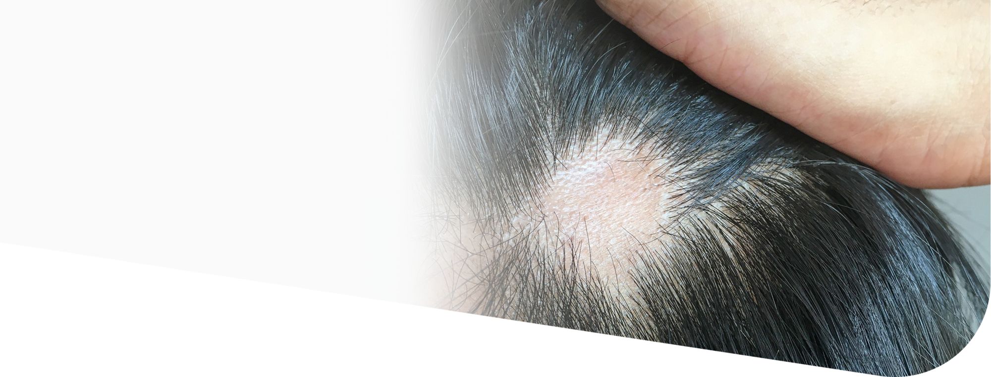 Микроспория (стригущий лишай): что это и почему возникает