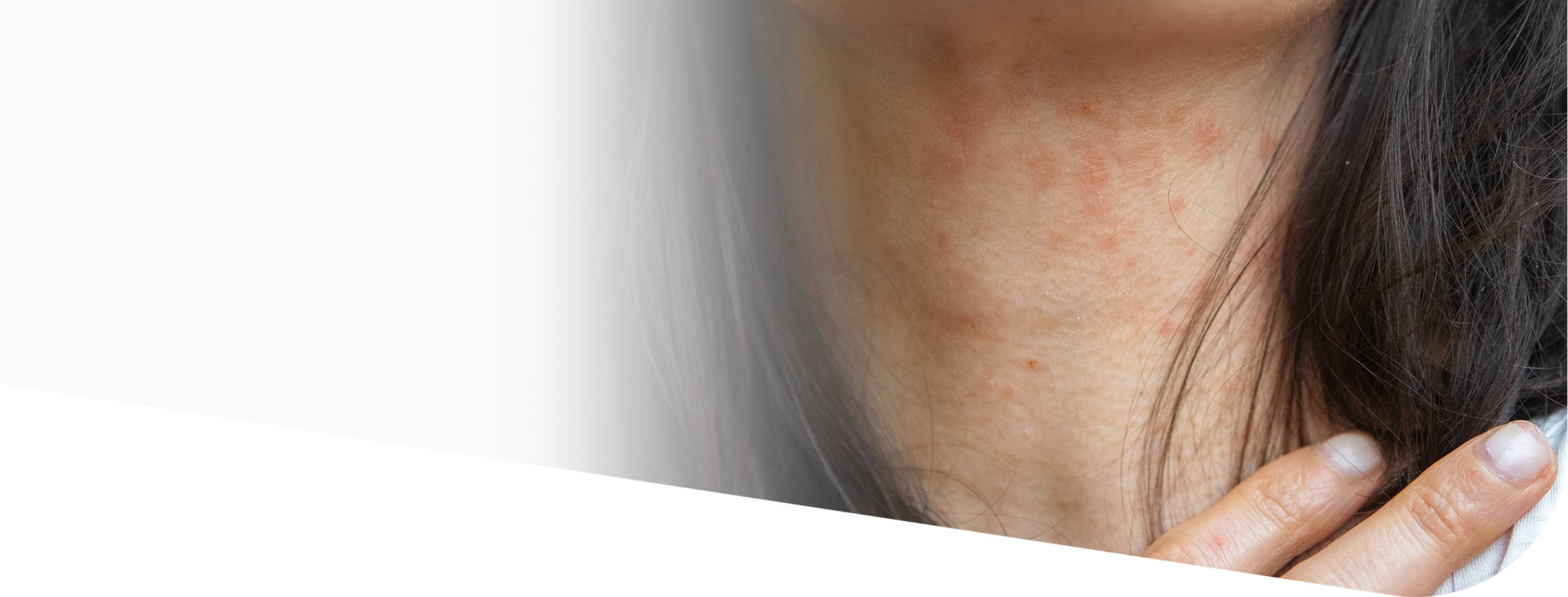 Нейродермит: симптомы и лечение