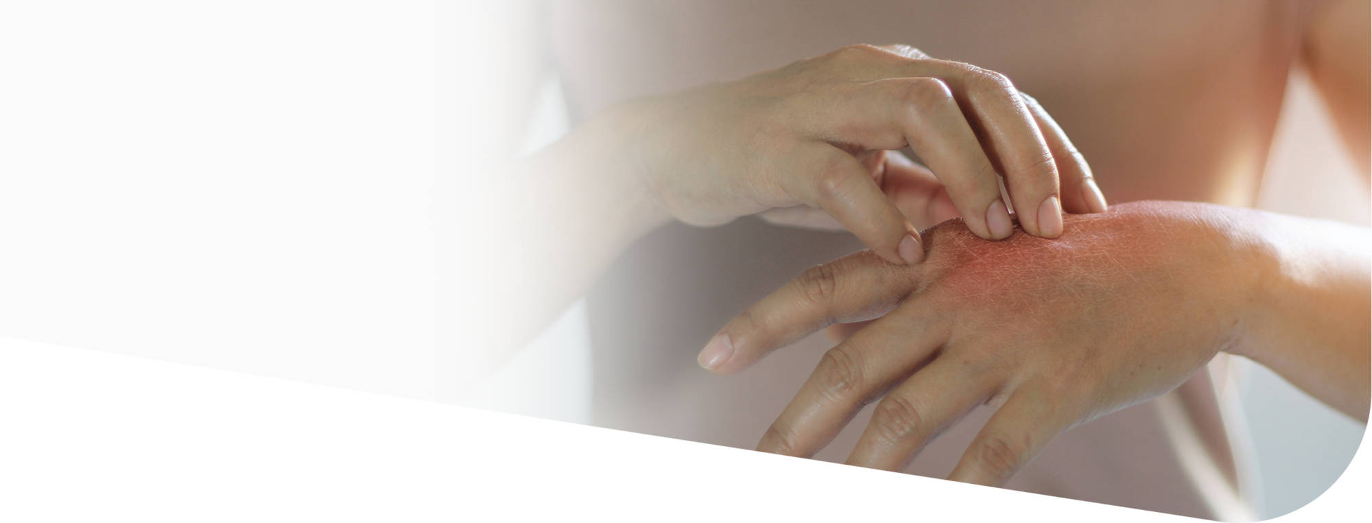 Экзема кожи: симптомы и лечение