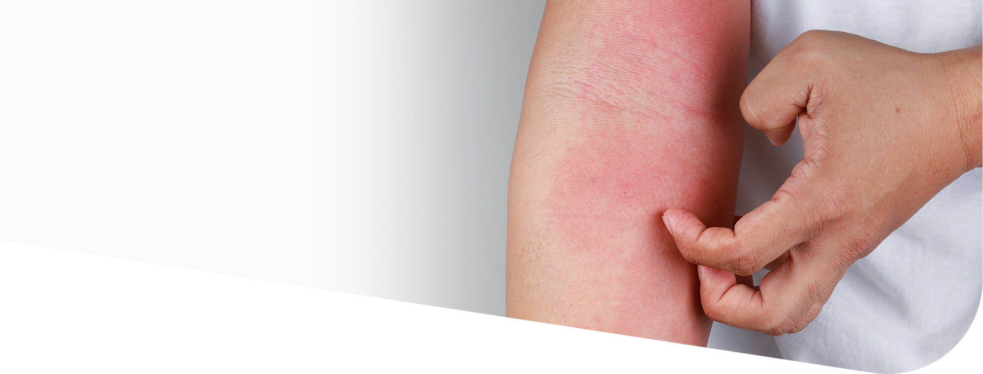 Атопический дерматит