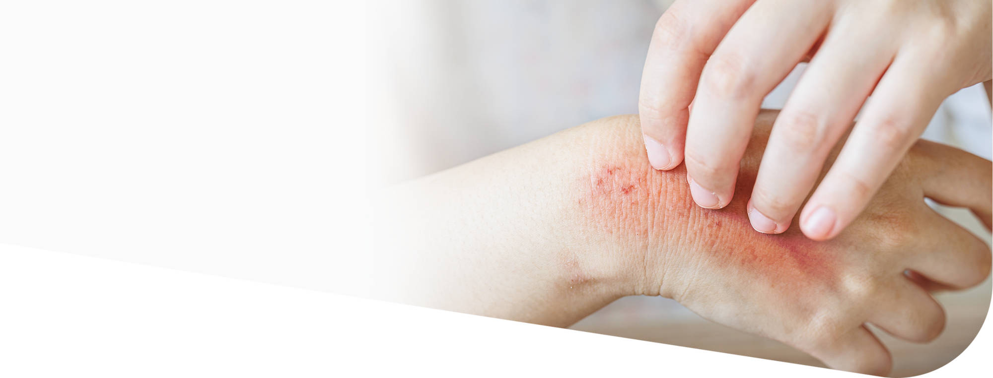 Экзема на руках